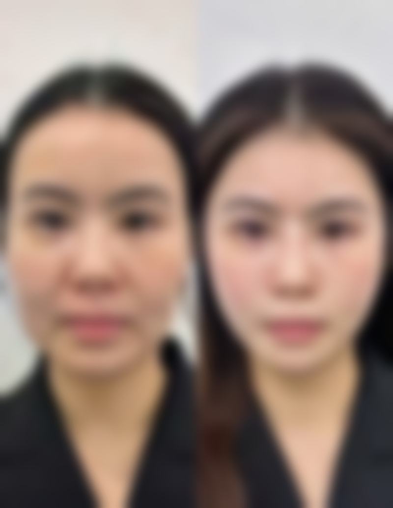 泰国Asia(亚洲)整形医院收费价格表(更新至2026年)