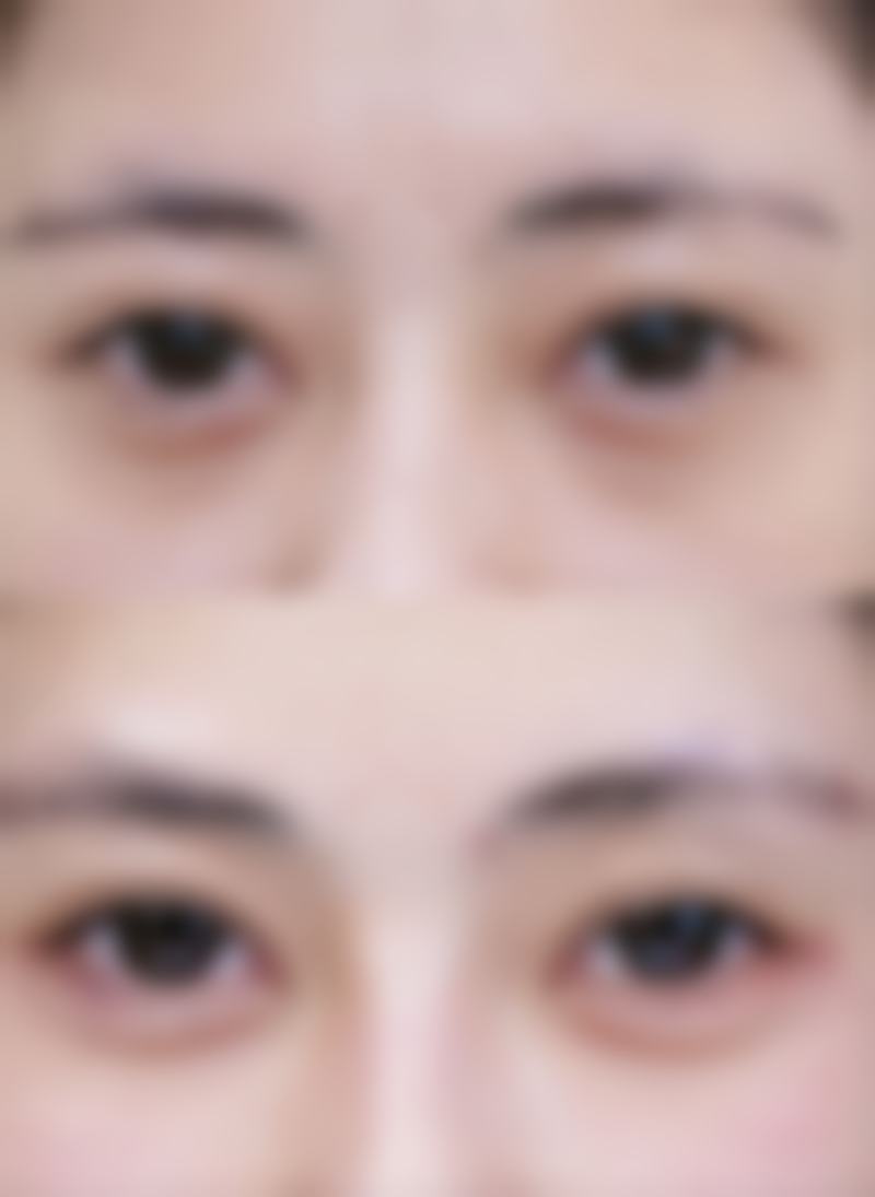 泰国Asia(亚洲)整形医院Tanongsak医生收费价格参考(2026年)