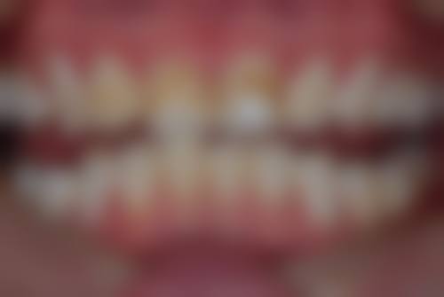 临床实例分享重庆存济口腔医院鲁珂珂