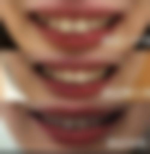 临床实例分享：重庆存济口腔医院陈娇