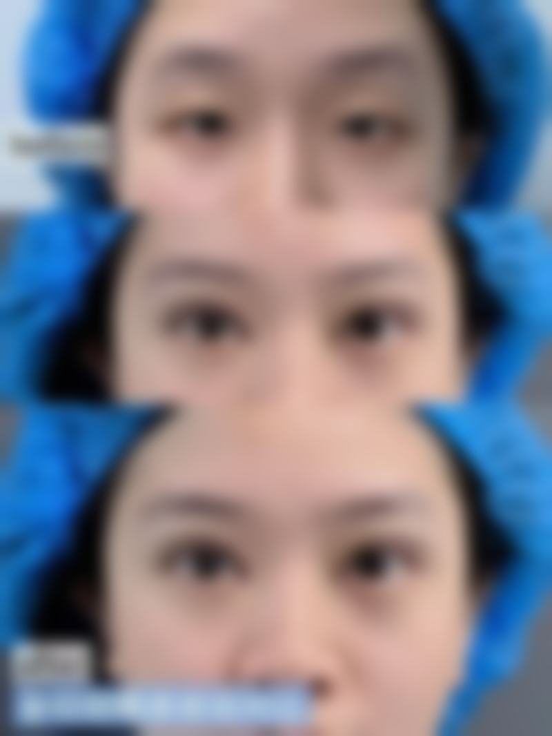 韩国波澜整形外科朴载贤医生真实口碑好评分享