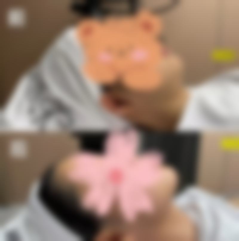 核心项目解析:胶原眼袋枪的优势与适用人群