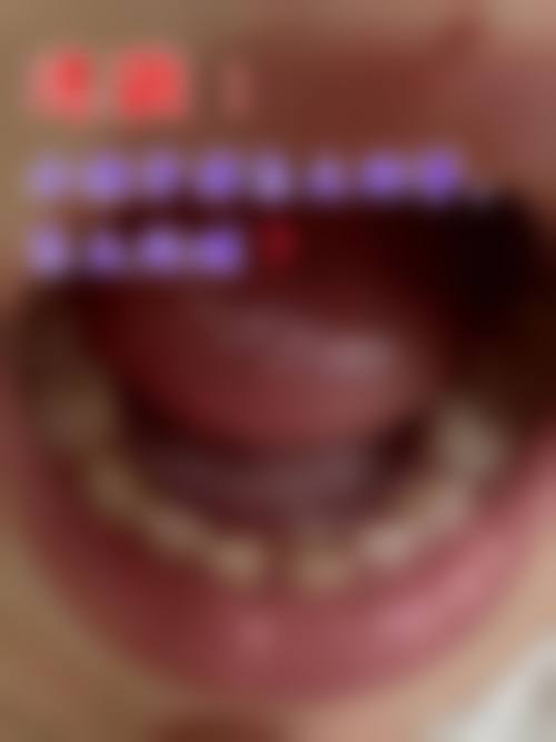 临床实例分享：珠海思创口腔门诊部邱志明