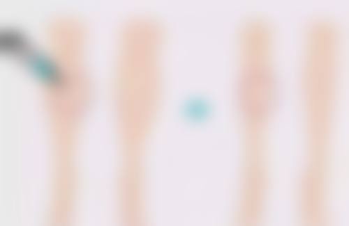 真实用户视角:Ultherapy Prime术后修复与变化